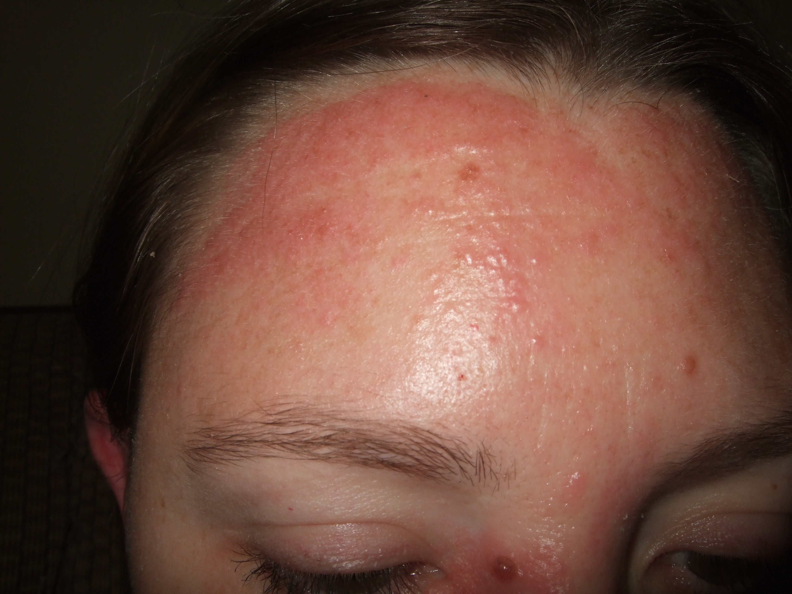 forehead rash